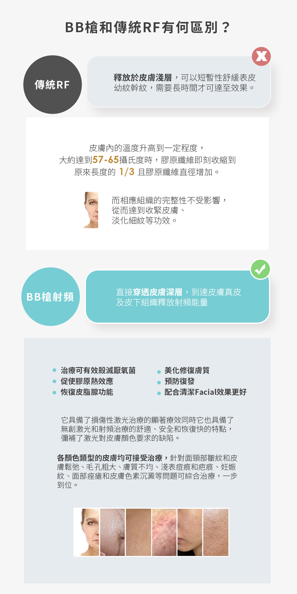 BB 槍與傳統 RF 射頻差異對比：深層作用、療效、適用膚質與功效說明