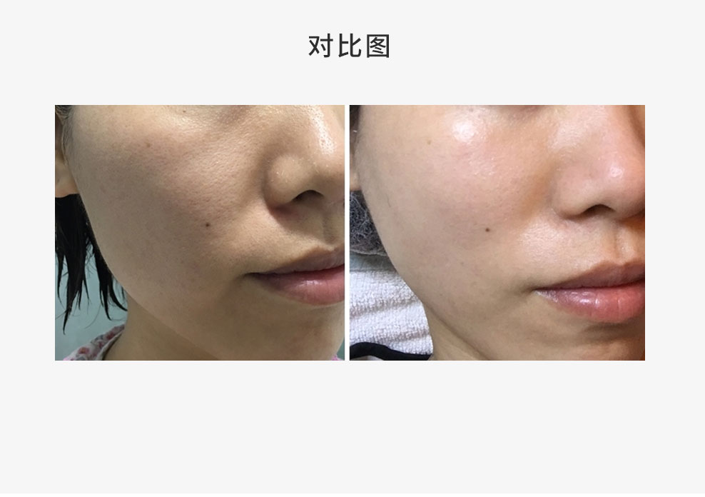 膠原 BB 槍療效前後對比圖