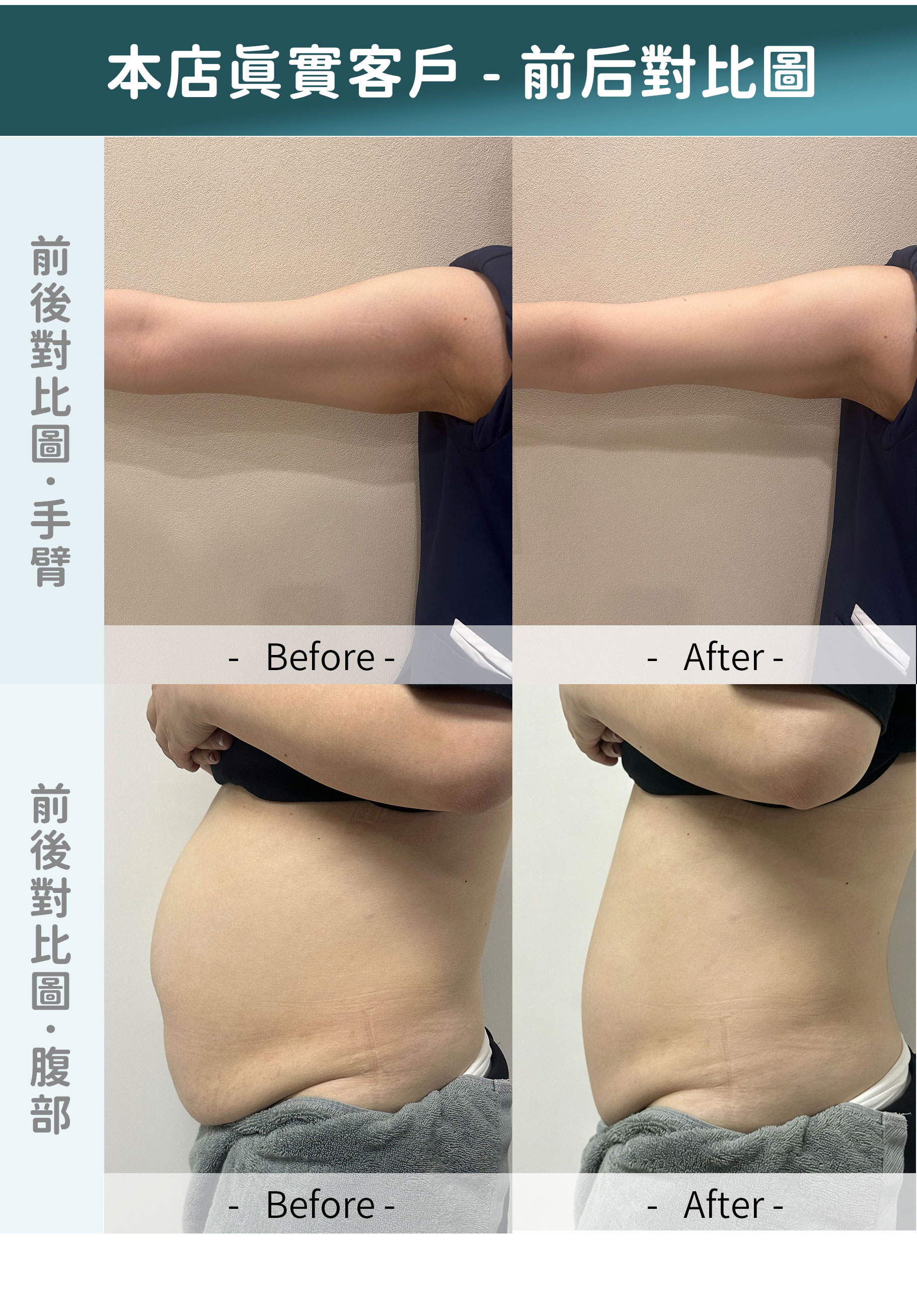 ONDA真實客戶對比 手臂腹部溶脂前後效果圖