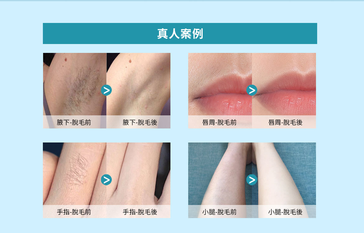 真人案例：腋下-脫毛前，腋下-脫毛後；唇周-脫毛前，唇周-脫毛後；手指-脫毛前，手指-脫毛後；小腿-脫毛前，小腿-脫毛後。