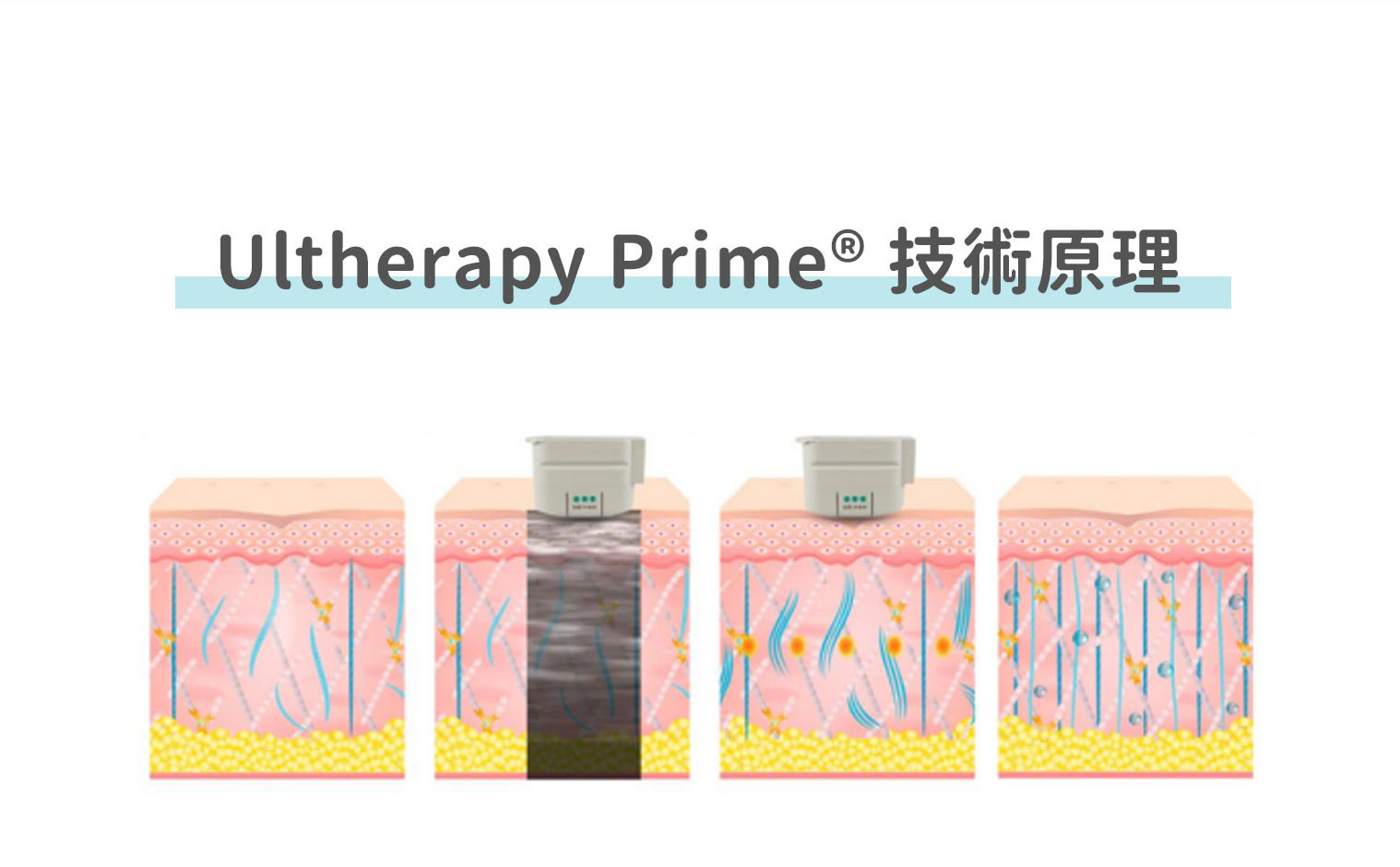 Ultherapy Prime 技術原理