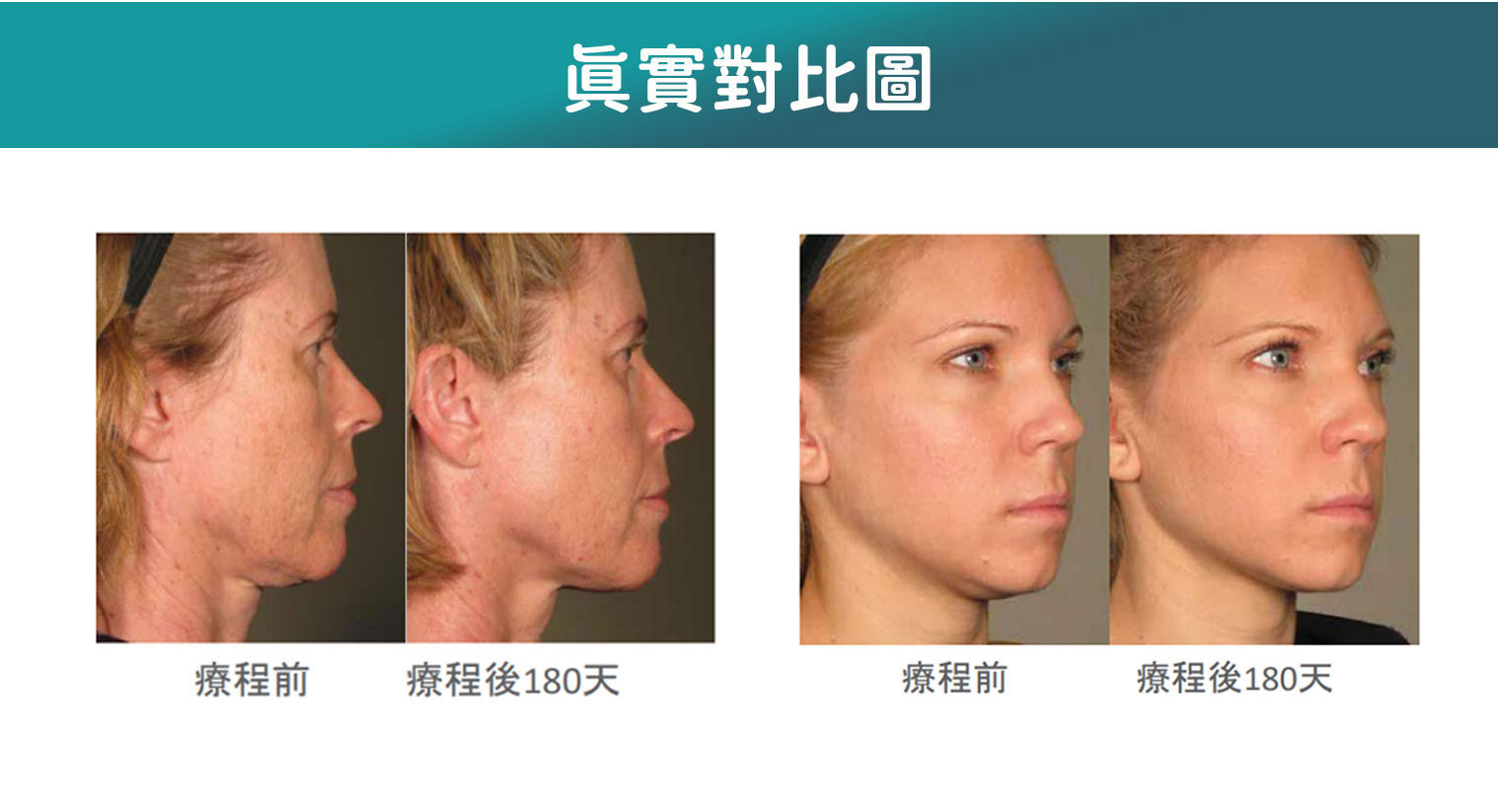 Ultherapy 真實對比圖，展示療程前與療程後 180 天的效果對照
